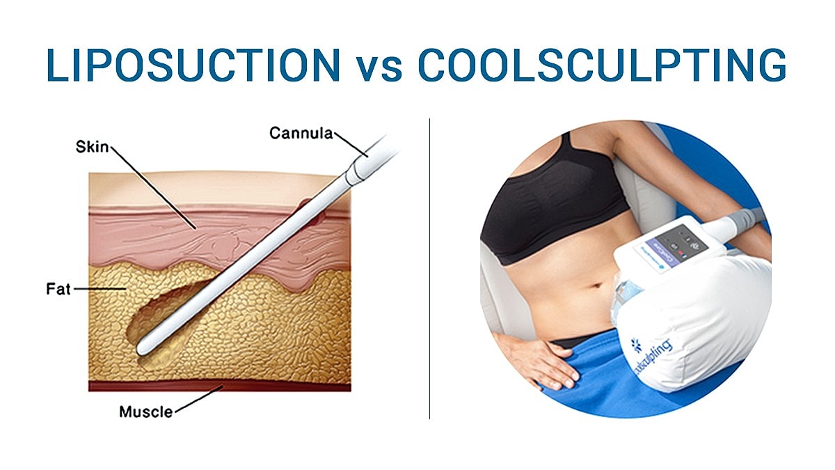 Liposuction vs CoolSculpting