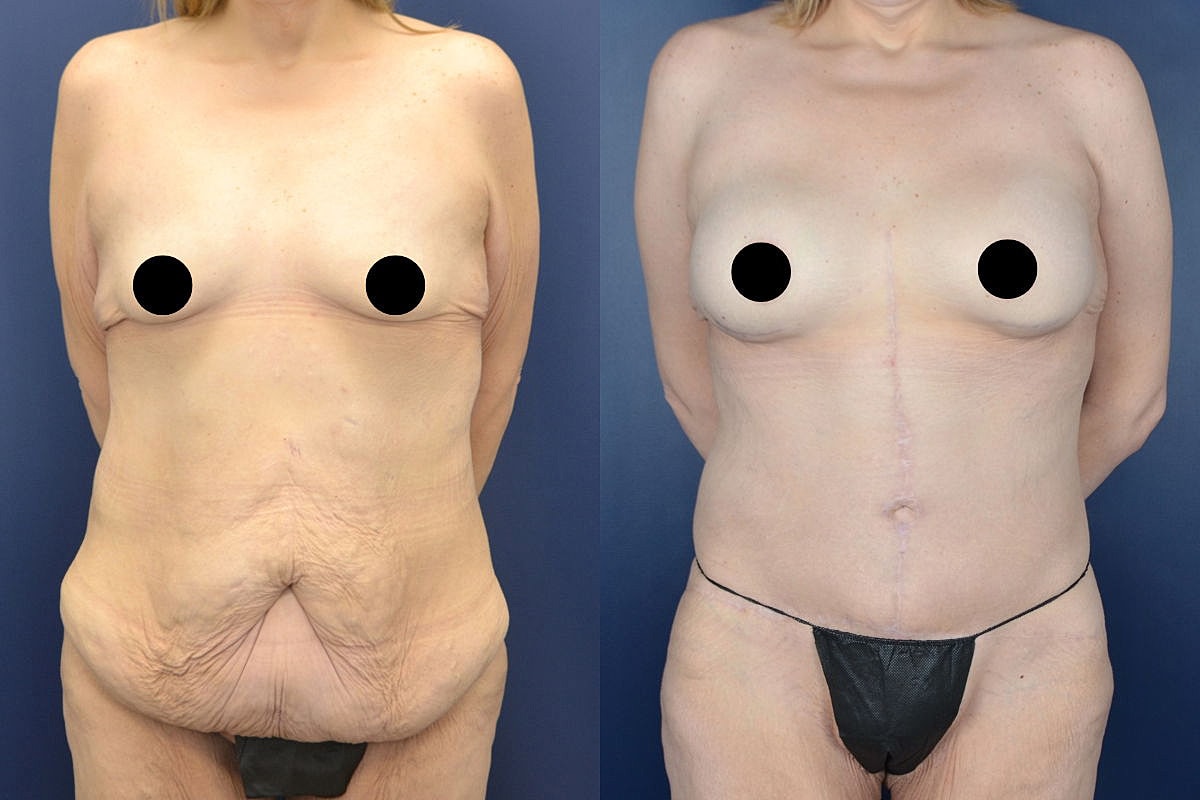 Before and after body transformation comparison.