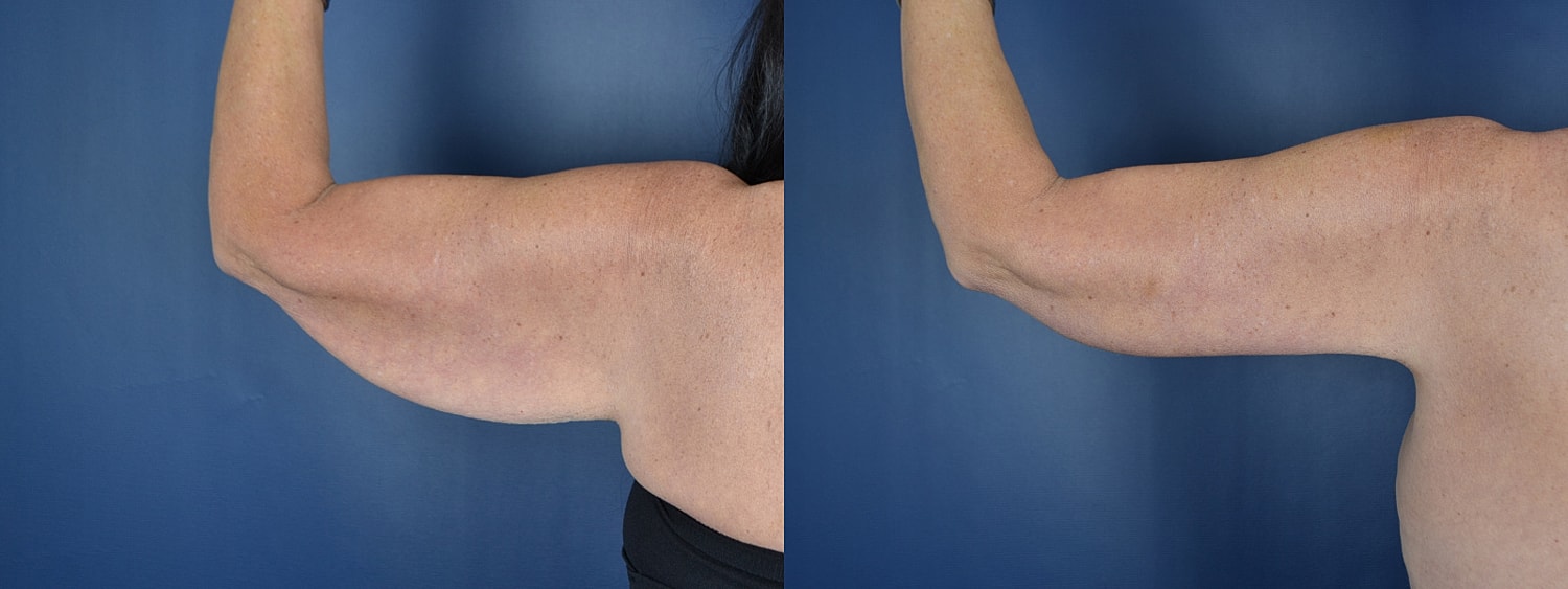 Before and after arm transformation comparison.