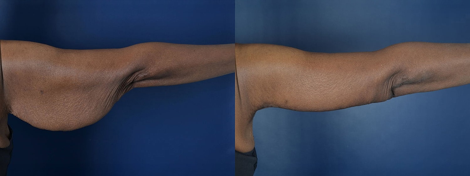 Before and after images of an arm.