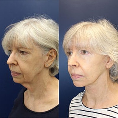 Facelift Before & after