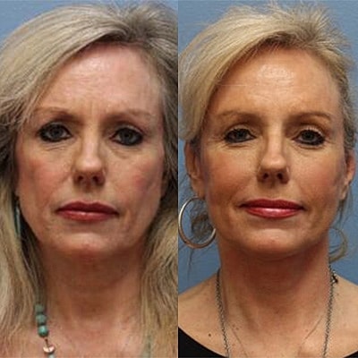 Facelift Before & after