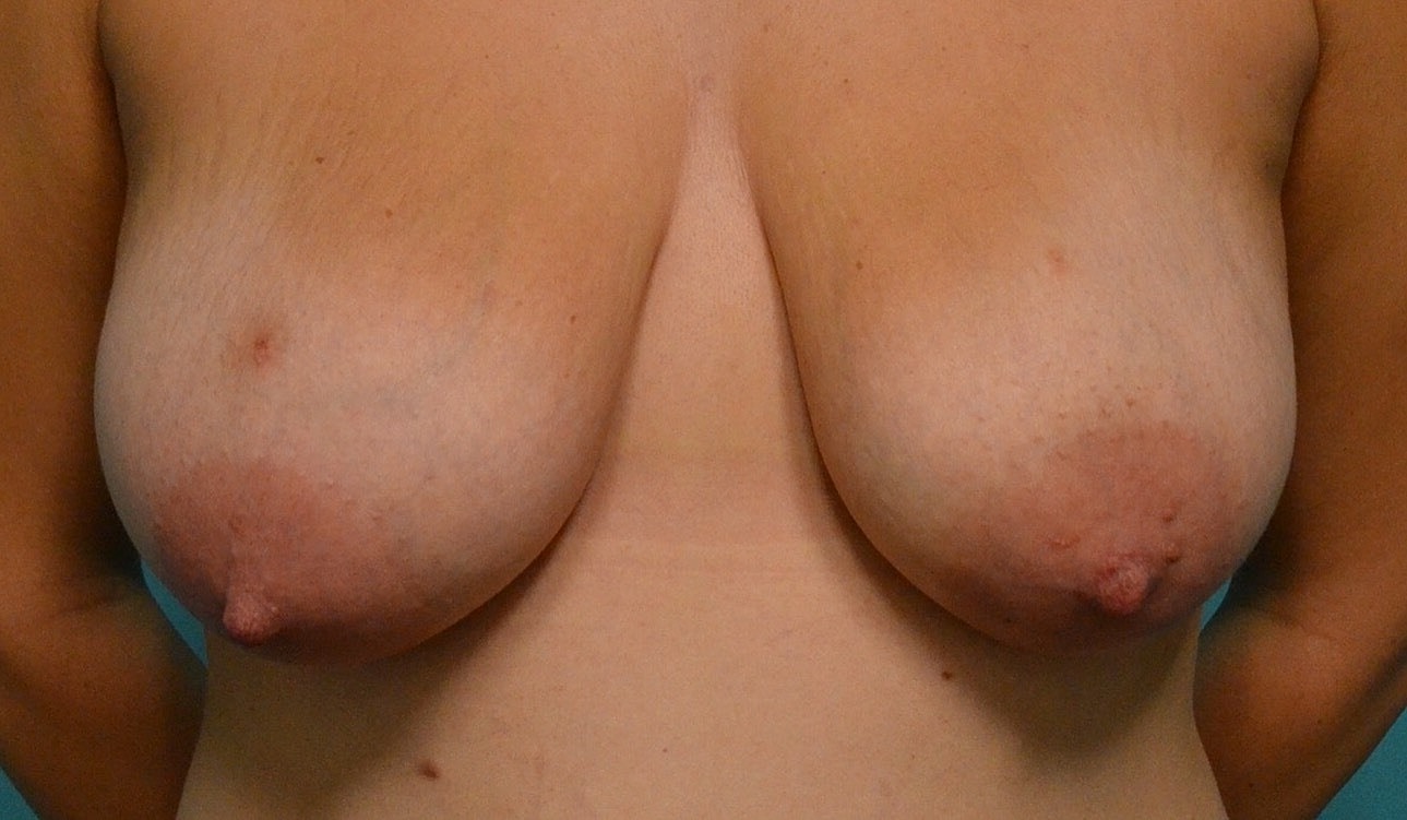 Breast Lift Before & After