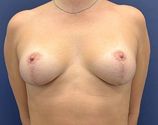 Breast Lift Before & After