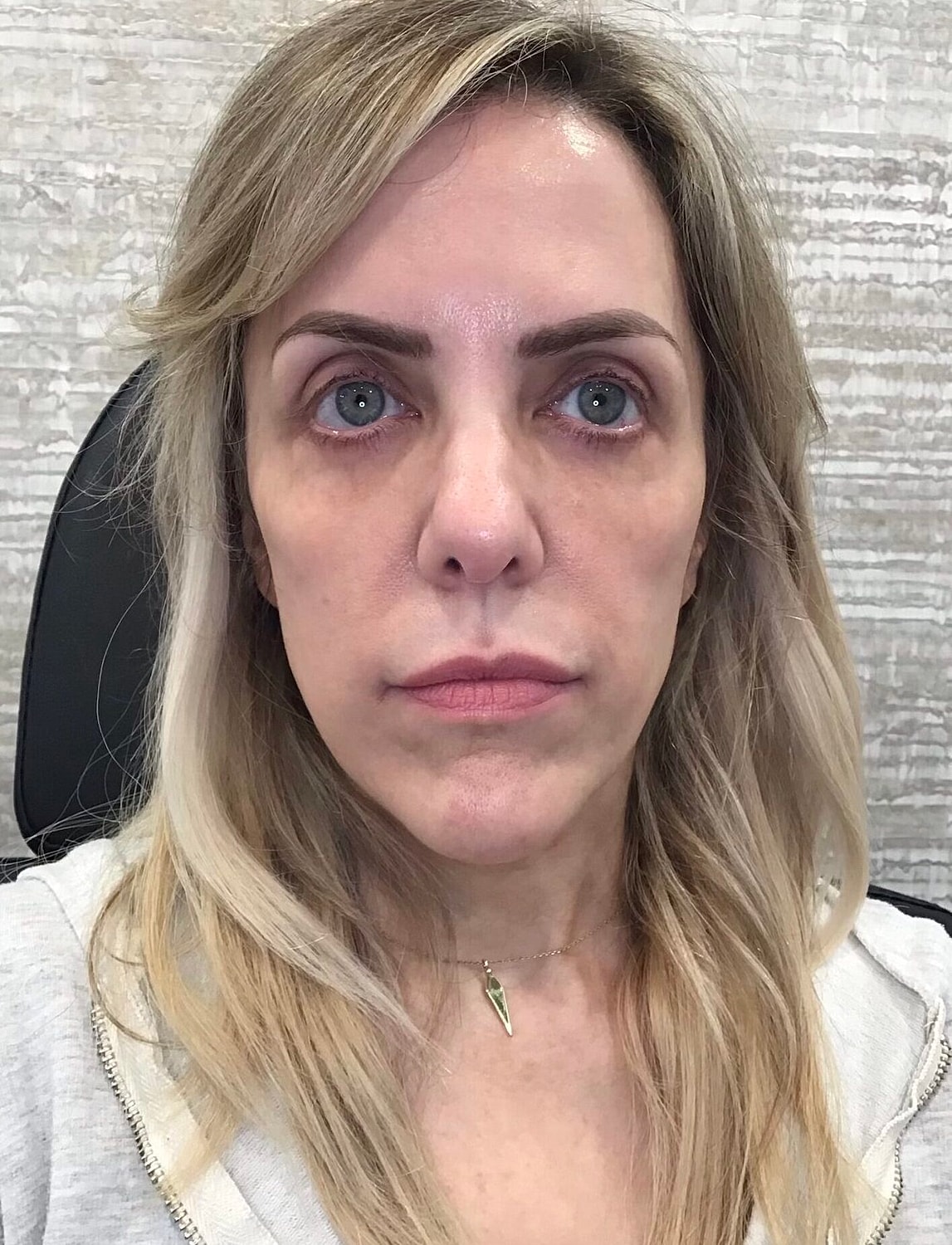 Sculptra Before & After