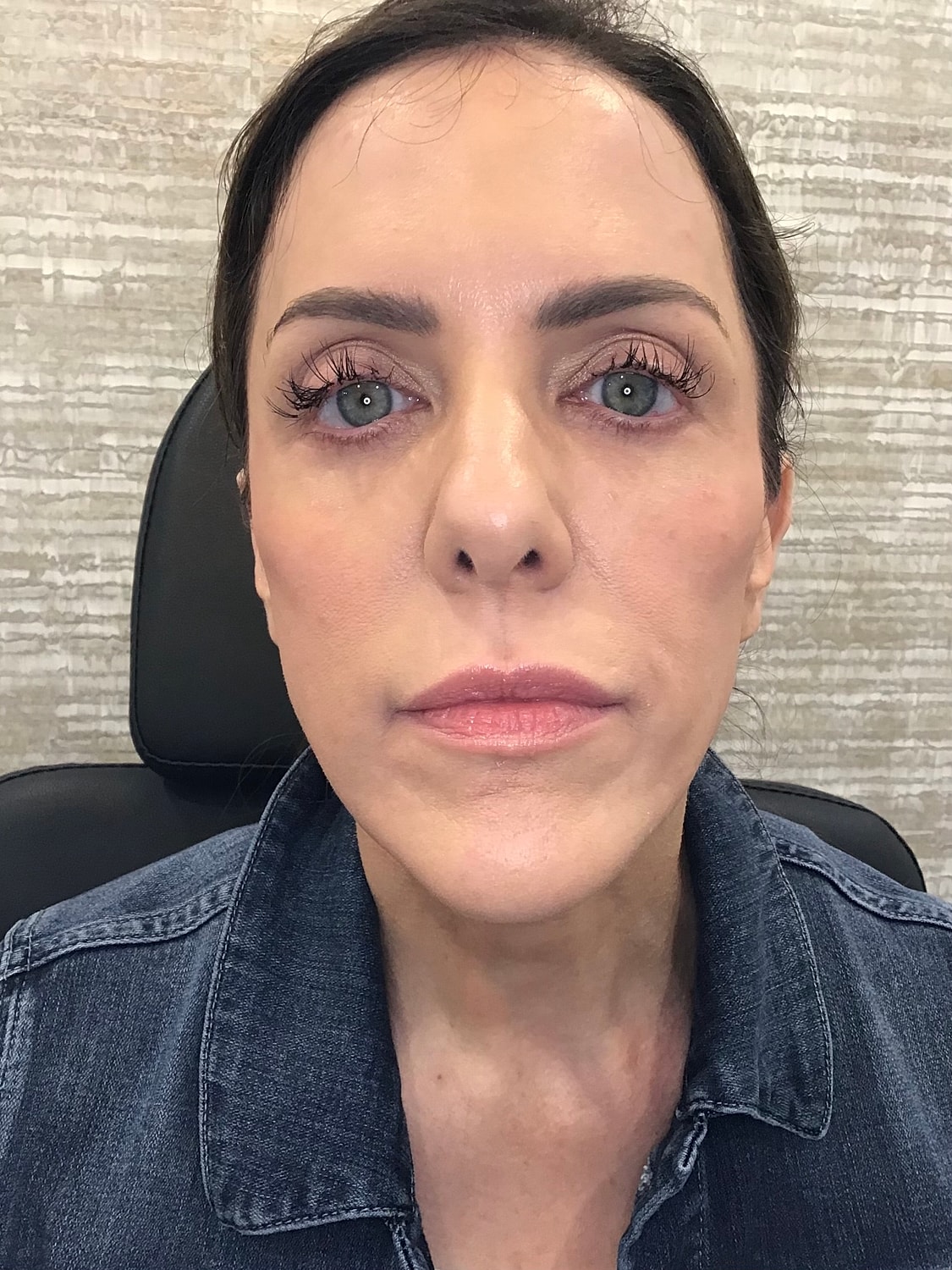 Sculptra Before & After