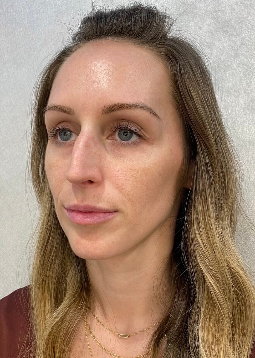 Sculptra Before & After