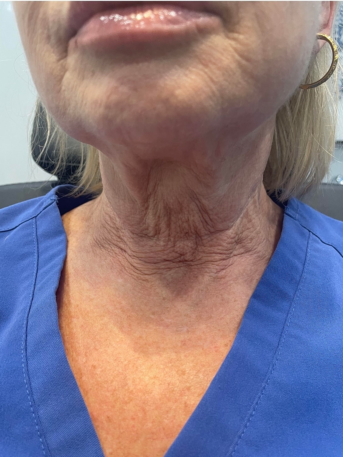 Skin Tightening Before & After