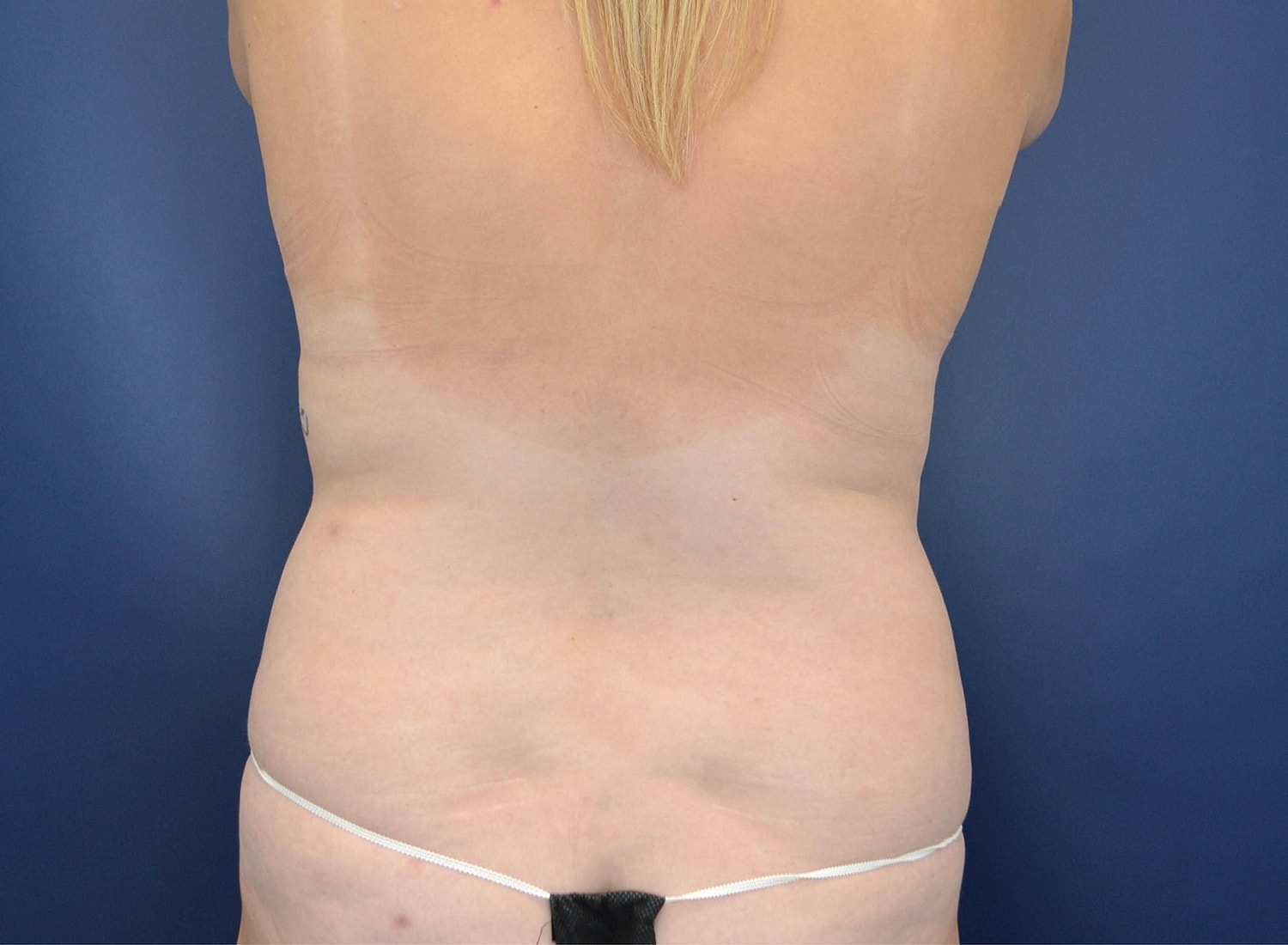 Skin Tightening Before & After