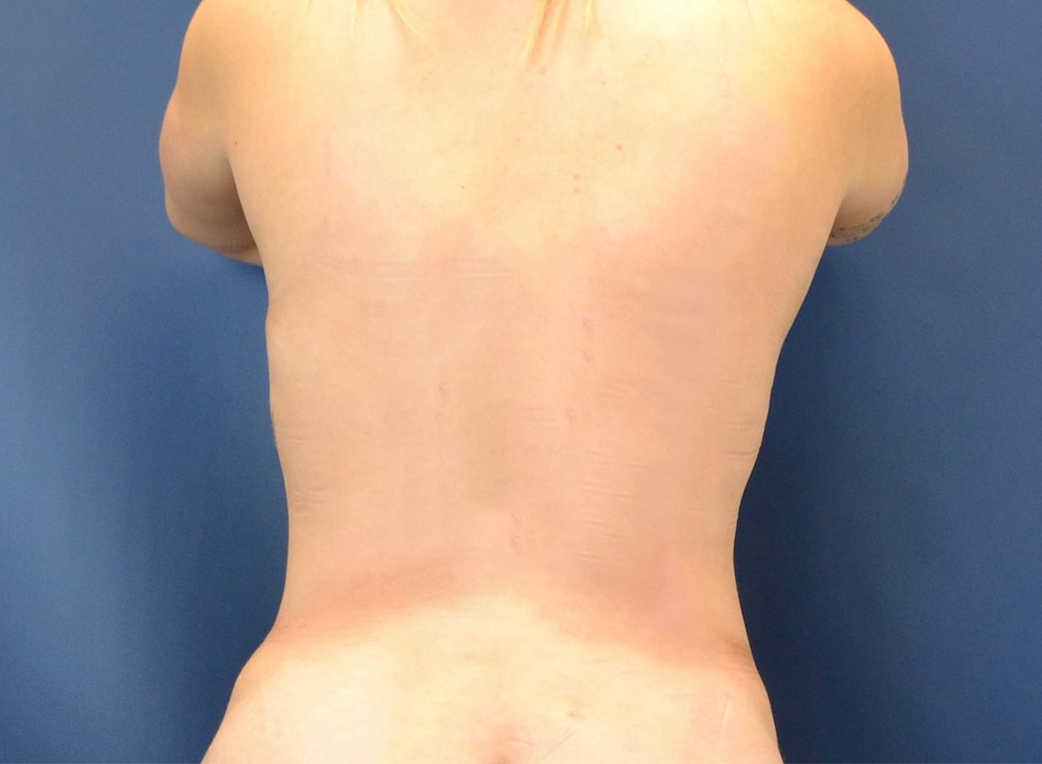 Skin Tightening Before & After