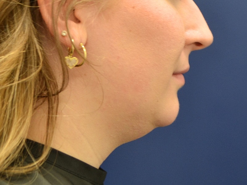 Skin Tightening Before & After