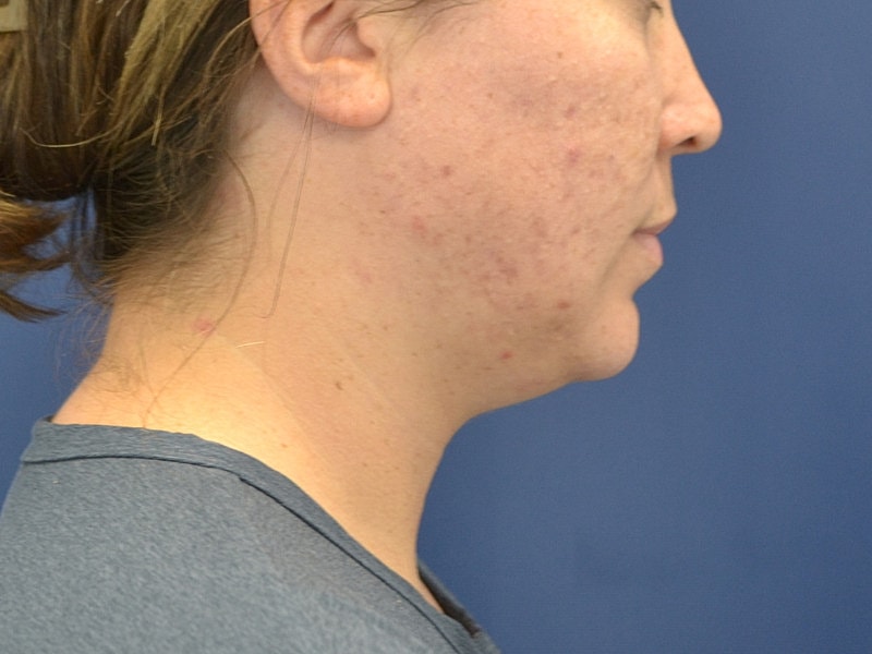 Skin Tightening Before & After