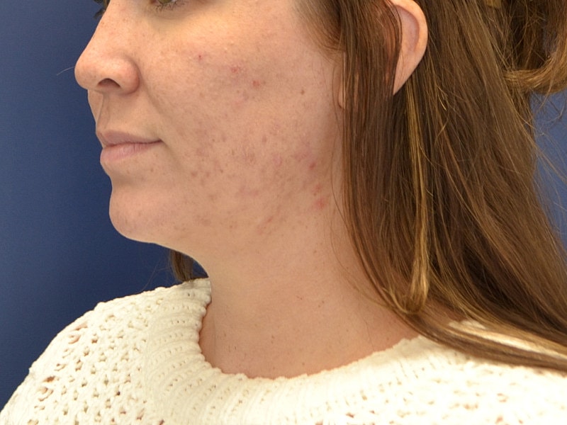 Skin Tightening Before & After