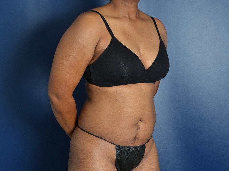 Skin Tightening Before & After