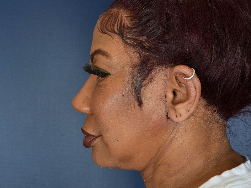Skin Tightening Before & After