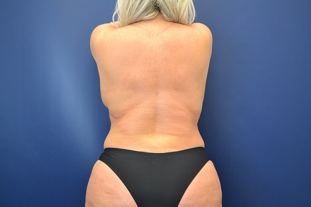 Skin Tightening Before & After