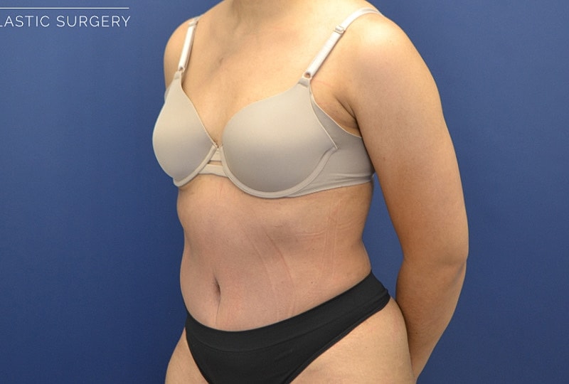 Skin Tightening Before & After