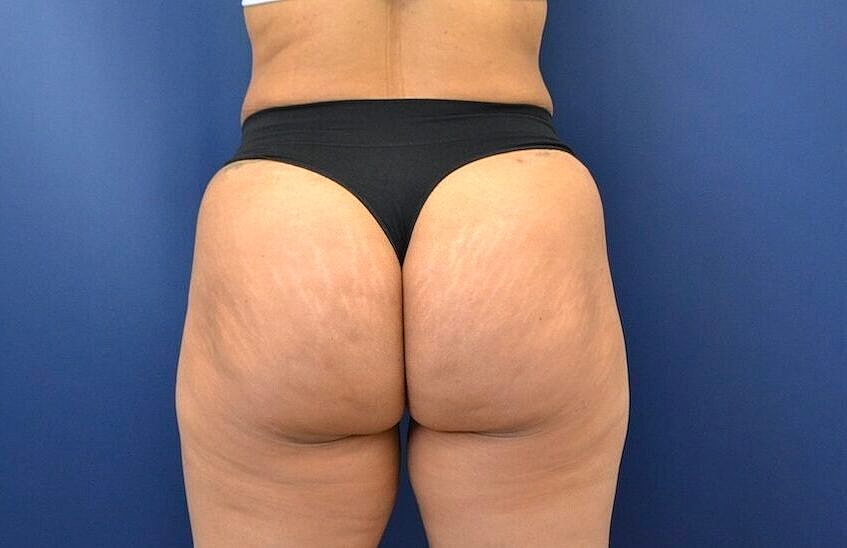 Brazilian Butt Lift Before & After