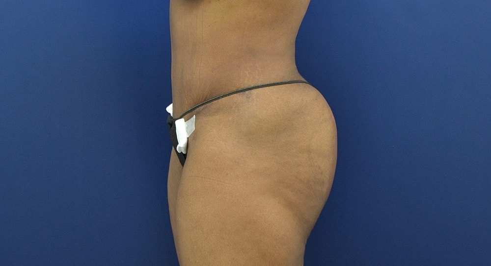 Brazilian Butt Lift Before & After