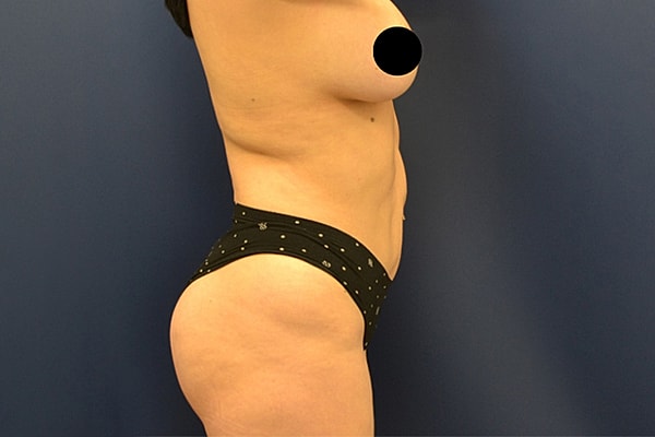 Brazilian Butt Lift Before & After