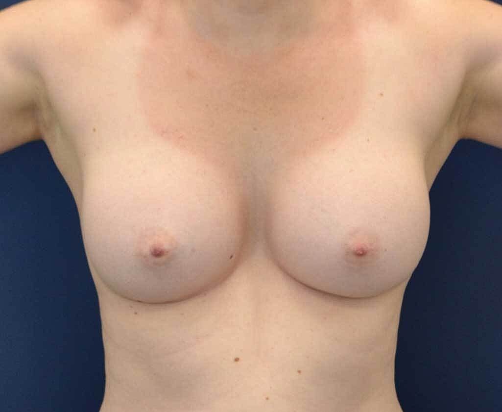 Breast Augmentation Before & After
