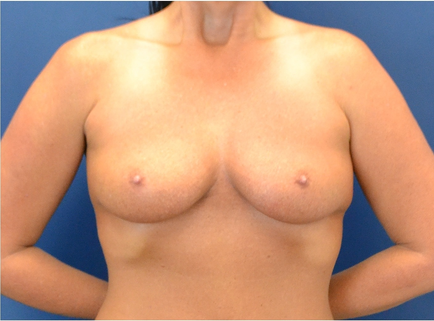 Breast Augmentation Before & After