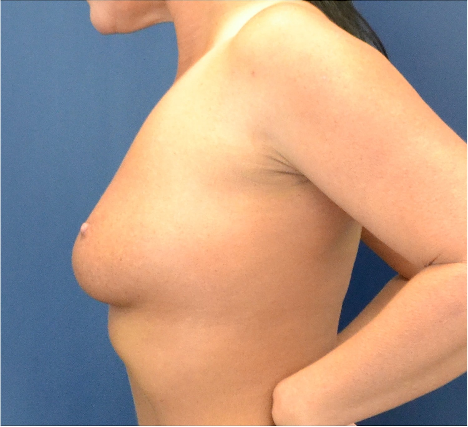 Breast Augmentation Before & After