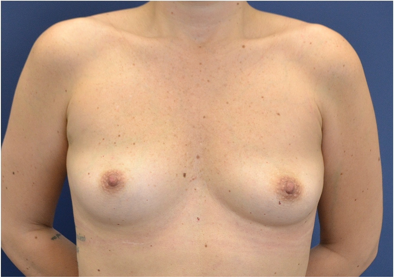 Breast Augmentation Before & After