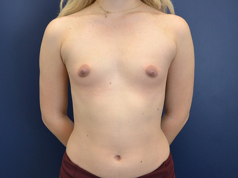 Breast Augmentation Before & After