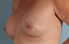 Breast Augmentation Before & After