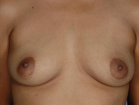 Breast Augmentation Before & After