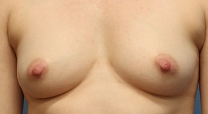 Breast Augmentation Before & After