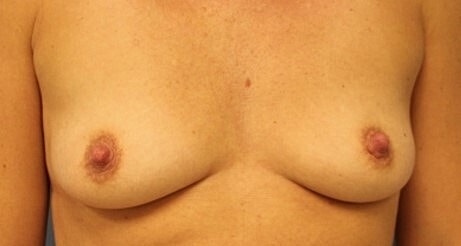 Breast Augmentation Before & After