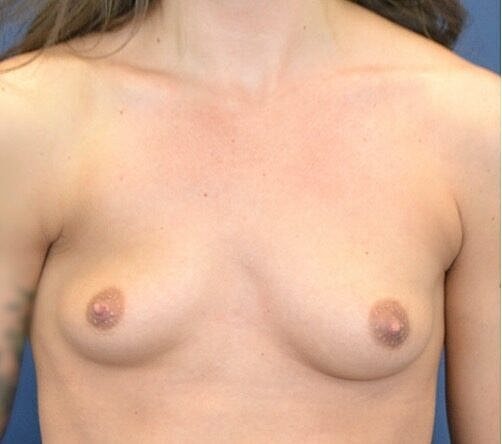 Breast Augmentation Before & After