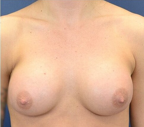 Breast Augmentation Before & After