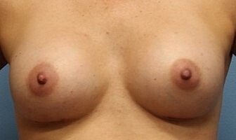Breast Augmentation Before & After