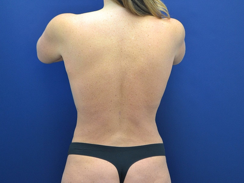 Breast Augmentation Before & After