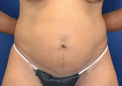 Tummy Tuck Before & After