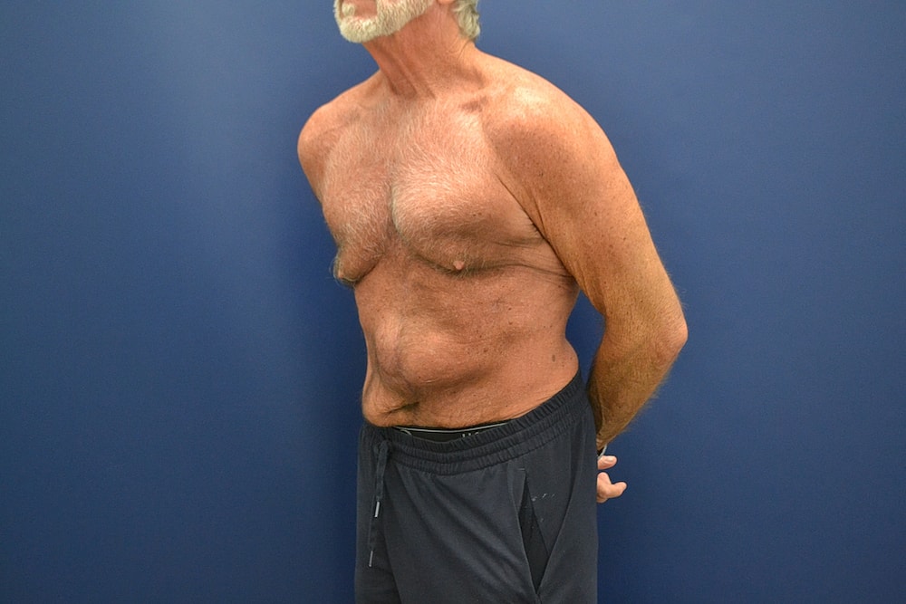 Tummy Tuck Before & After
