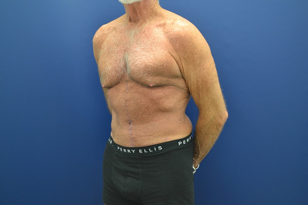 Tummy Tuck Before & After