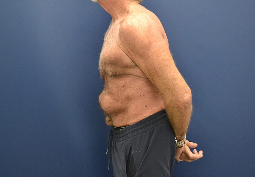 Tummy Tuck Before & After
