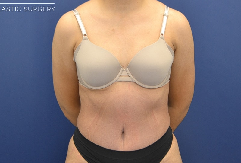 Tummy Tuck Before & After