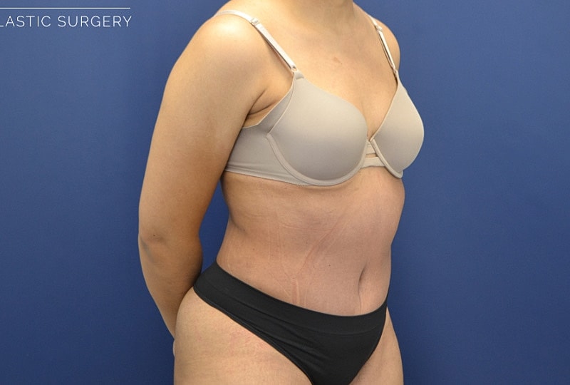 Tummy Tuck Before & After