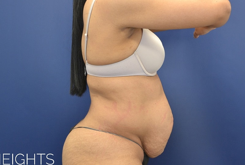 Tummy Tuck Before & After