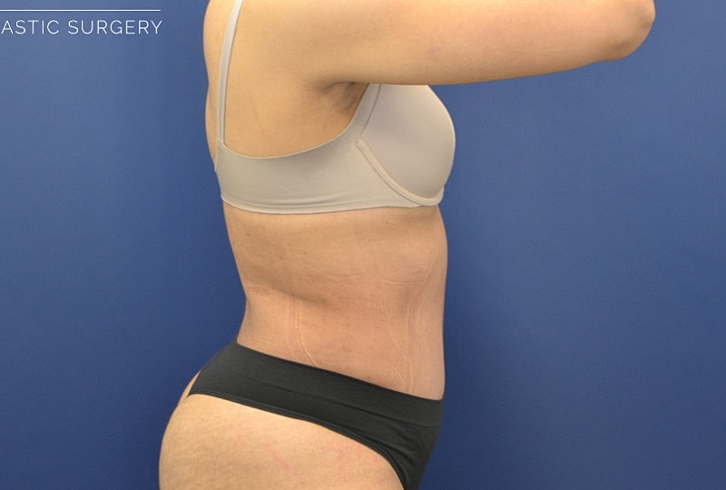 Tummy Tuck Before & After