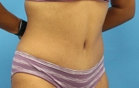 Tummy Tuck Before & After