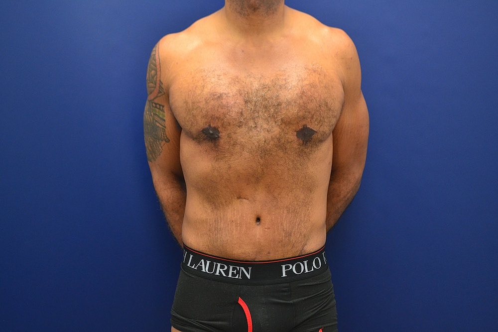 Tummy Tuck Before & After