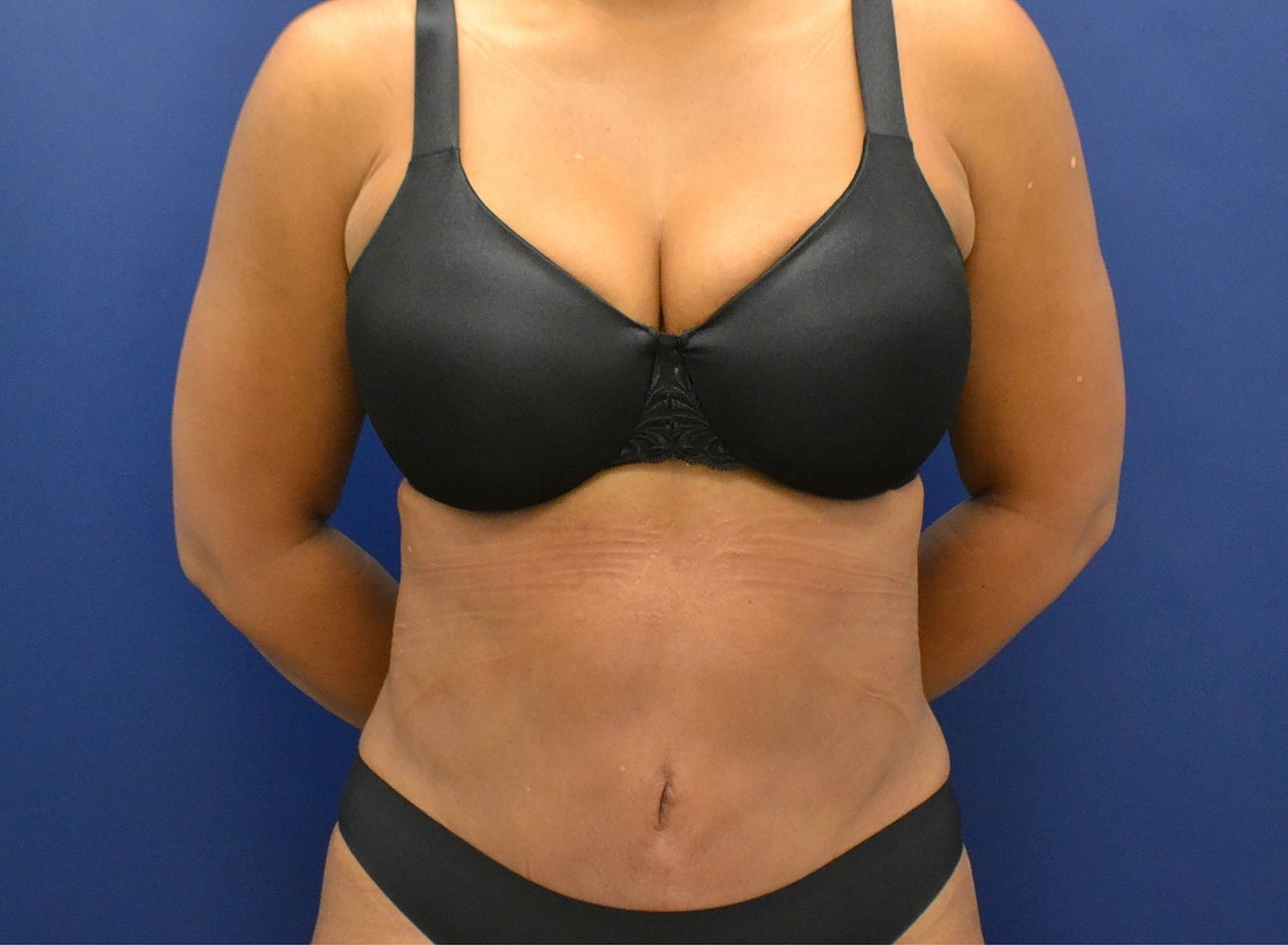 Tummy Tuck Before & After