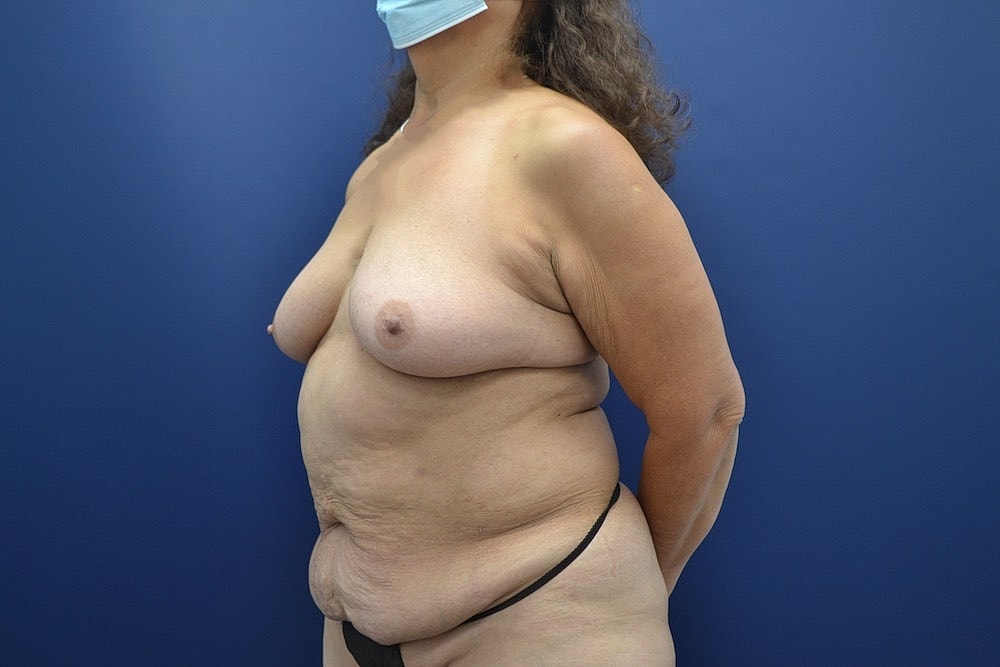 Tummy Tuck Before & After