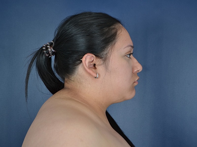 Liposuction Before & After